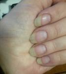 Белые полосы на ногтях, бледный цвет ногтей фото 1