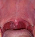 Болит язык и горло фото 3