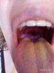 Большие шишки или бугры в горле на корне языка фото 2