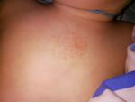 Аллергия, высыпания на теле, пятна фото 3