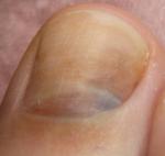 Темное пятно на ногте большого пальца ноги фото 3