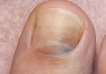 Темное пятно на ногте большого пальца ноги фото 2