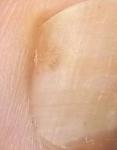 Темное пятно на ногте большого пальца ноги фото 5