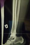 Болит нога уже пол года, разные диагнозы фото 1