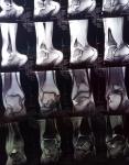 Болит нога уже пол года, разные диагнозы фото 4