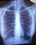 Есть ли подозрение на туберкулез? фото 4
