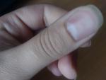 Уплотнение на ногте фото 1