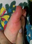 Красные подушечки пальцев на ногах фото 3