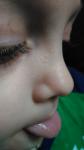 Сгруппированная мелкая сыпь на носу у ребенка фото 2