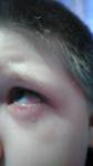 Покраснение глаз у ребенка во время простуды фото 2