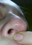 Нарост на носовой перегородке, сопровождается умеренными болевыми ощущениями фото 1