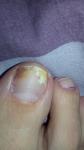 Пятно на ногте большом пальце ноги фото 1