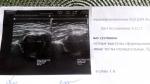 Дисплазия правого тазобедренного сустава у 6 месячной малышки фото 2