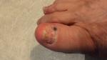 Не проходит гематома под ногтем большого пальца ноги фото 3