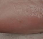 Пигментное пятно на ноге фото 3