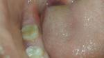Трещина на жевательном зубе фото 4