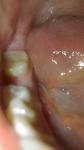 Трещина на жевательном зубе фото 3
