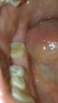 Трещина на жевательном зубе фото 2
