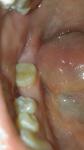 Трещина на жевательном зубе фото 1
