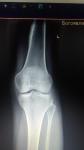 Неровность кости на рентгене фото 1