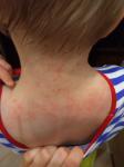 Ужасная сыпь у ребенка на плечах, шее фото 1