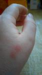 Красные пятна, похожие на укусы комаров фото 2