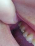 Болит зуб без нерва и отдает в скулу фото 1