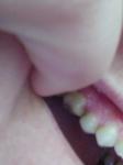 Болит зуб без нерва и отдает в скулу фото 2