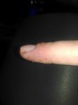 Появились пузыри на пальцах рук, затем потрескалась кожа фото 1