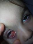 Травма глаза тупым карандашом фото 1