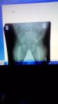 Расшифровка рентгена тазобедренного сустава фото 1