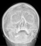 Интерпритация рентгеновского снимка пазух носа фото 1