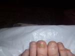 Большом пальце ноги на ногте стала видна какая-то желтизна фото 1