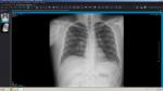 Рентген и боли в груди фото 2