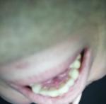 Нарост около верхнего зуба фото 1