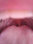 Воспаление во рту фото 1