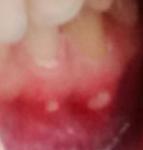 Гнойники на деснах после плобмировки зуба фото 1