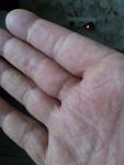 Кожное заболевание ладоней и пальцев рук фото 3