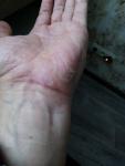Кожное заболевание ладоней и пальцев рук фото 1