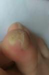 Появление небольшого новообразования на пальце ноги фото 1