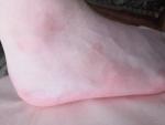Розовые морщинистые пятна на ноге у ребёнка 12 лет. Не беспокоят фото 2
