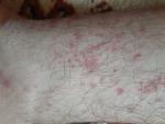 Аллергия на руках и ногах фото 1