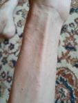 Аллергия на руках и ногах фото 2