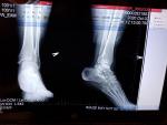 Подвернула ногу (травма голеностопного сустава) фото 1