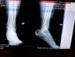Подвернула ногу (травма голеностопного сустава) фото 2