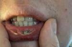 Рассечение нижней внутренней части губы фото 2