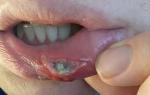 Рассечение нижней внутренней части губы фото 4