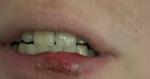 Рассечение нижней внутренней части губы фото 3