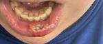 Рассечение нижней внутренней части губы фото 5