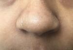 Помощь с определением диагноза кожа лица пятно зуд себорея сухая фото 2